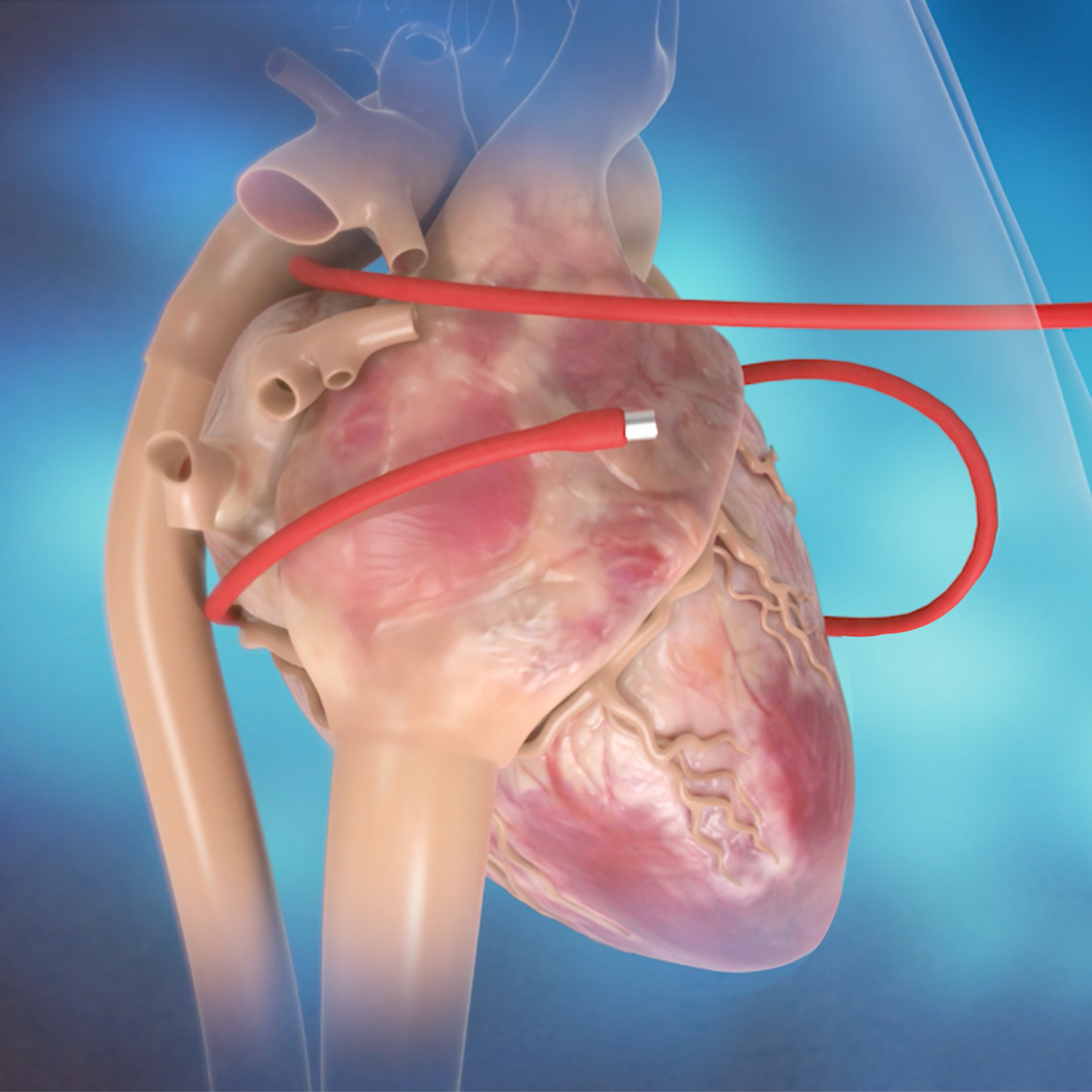 Isolator Synergy Clamp Atrial Fibrillation Treatment (Afib